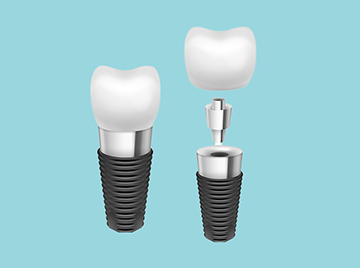 What Are Dental Implants? A Comprehensive Guide