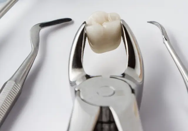 Tooth Extraction