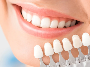How Long Do Dental Veneers Last and What Really Affects Their Lifespan?